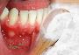 درمان فوری آفت دهان با جوش شیرین