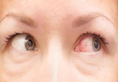 علائم عفونت چشم چیست