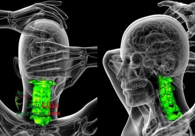 آرتروز گردن چیست