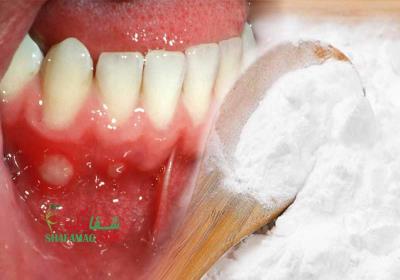 درمان فوری آفت دهان با جوش شیرین