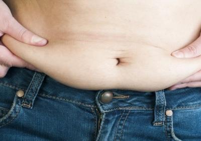 درمان افتادگی پوست شکم بعد از زایمان